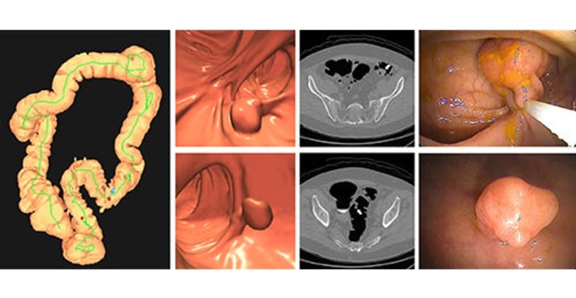 Image: Images of positive CT colonography screening examination result in an asymptomatic 67-year-old man (Photo courtesy of Radiology) Image: Images of positive CT colonography screening examination result in an asymptomatic 67-year-old man (Photo courtesy of Radiology)