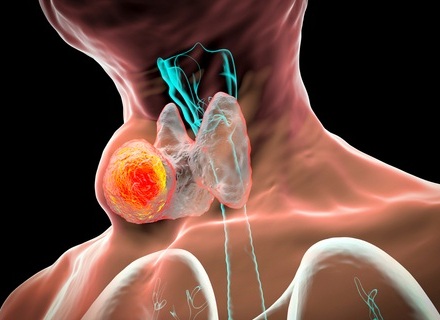 Image: AI-driven analysis of CT scans helps identify oropharyngeal cancer patients who may need more or less aggressive treatment (Photo courtesy of Shutterstock)