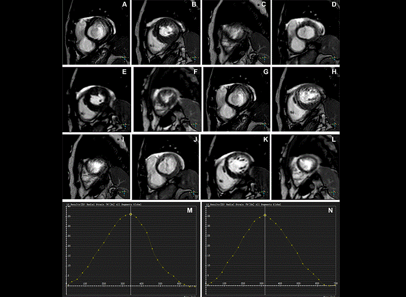Representative images of participants with difficulty with breath holding and arrhythmia (Photo courtesy of RSNA; https://doi.org/10.1148/ryct.250298) 