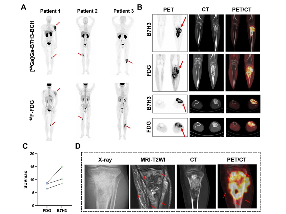 Image: (A-C) Representative whole-body maximum-intensity projection images and regional fused PET/CT images from three histologically confirmed osteosarcoma patients who underwent paired [68Ga]Ga-B7-H3-BCH PET/CT and 18F-FDGE PET/CT within 7 days. (D) Multimodal imaging evaluation of patient 3, including X-ray, MRI (T2-weighted imaging, T2WI), CT, and B7-H3 PET/CT. (Photo courtesy of SNMMI)