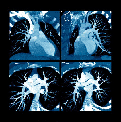 Image: Colored computed tomography (CT) scan of the healthy heart of a 23 year-old with coronal views at the top, and axial views at the bottom (Photo courtesy of Zephyr / SPL).