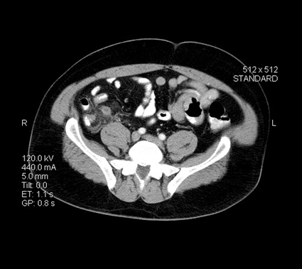 Image: Axial cross-sectional CT image through the upper pelvis showing acute appendicitis, with an enlarged appendix and streaky inflammatory changes in the surrounding mesenteric fat (Photo courtesy of Living Art Enterprises).