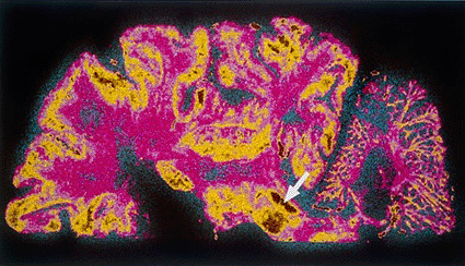 Image: Colored MRI scan of a coronal section through the brain showing Parkinson’s disease. The arrow area shows degeneration in the substantia nigra in the basal ganglia of the brain (Photo courtesy of BSIP, Cavallini James). Image: Colored MRI scan of a coronal section through the brain showing Parkinson’s disease. The arrow area shows degeneration in the substantia nigra in the basal ganglia of the brain (Photo courtesy of BSIP, Cavallini James).