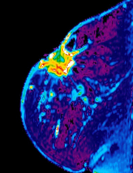 Image: Colored magnetic resonance imaging (MRI) scan of breast cancer (Photo courtesy of the National Cancer Institute). Image: Colored magnetic resonance imaging (MRI) scan of breast cancer (Photo courtesy of the National Cancer Institute).