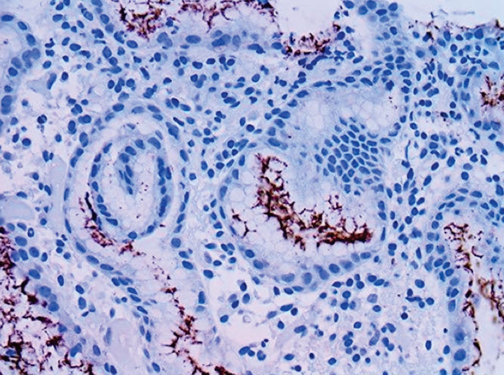 Иммуногистохимическое окрашивание Helicobacter pylori на зафиксированной в формалине и залитой парафином инфицированной ткани желудка (фото любезно предоставлено Bio SB). Иммуногистохимическое окрашивание Helicobacter pylori на зафиксированной в формалине и залитой парафином инфицированной ткани желудка (фото любезно предоставлено Bio SB).